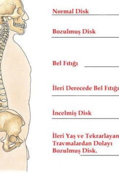 Bel Fıtığı Belirtileri Nelerdir? Bel Fıtığına Ne İyi Gelir ?