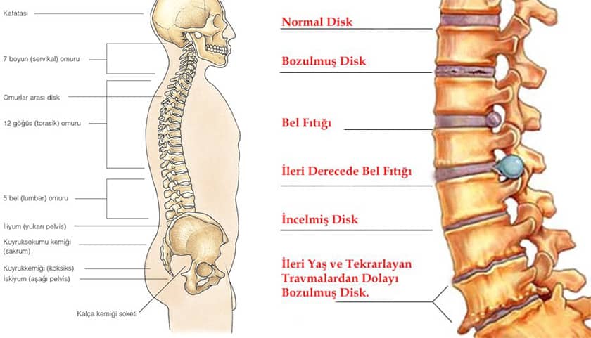 Bel Fıtığı Belirtileri Nelerdir? Bel Fıtığına Ne İyi Gelir ?