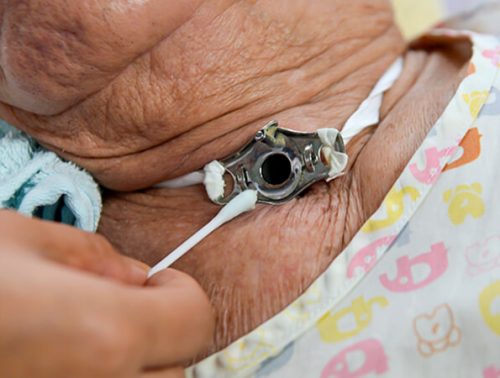 Evde Trakeostomi Bakımı ve Değişimi1