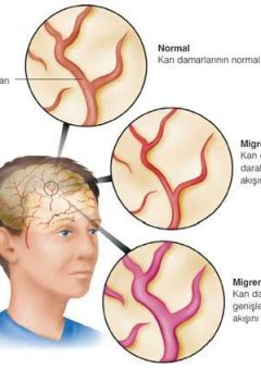 Migren Belirtileri